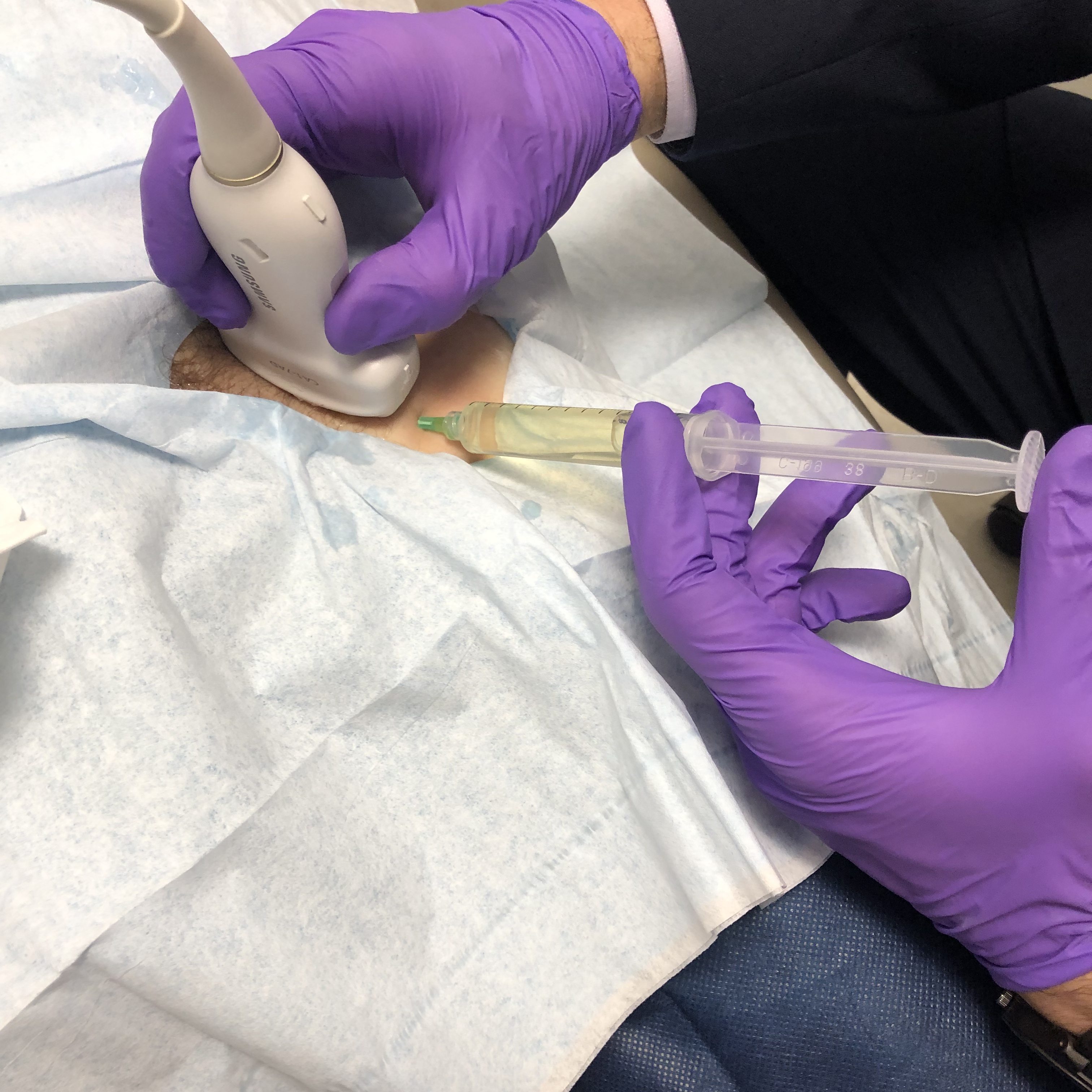 Ultrasound-guided PRP injection